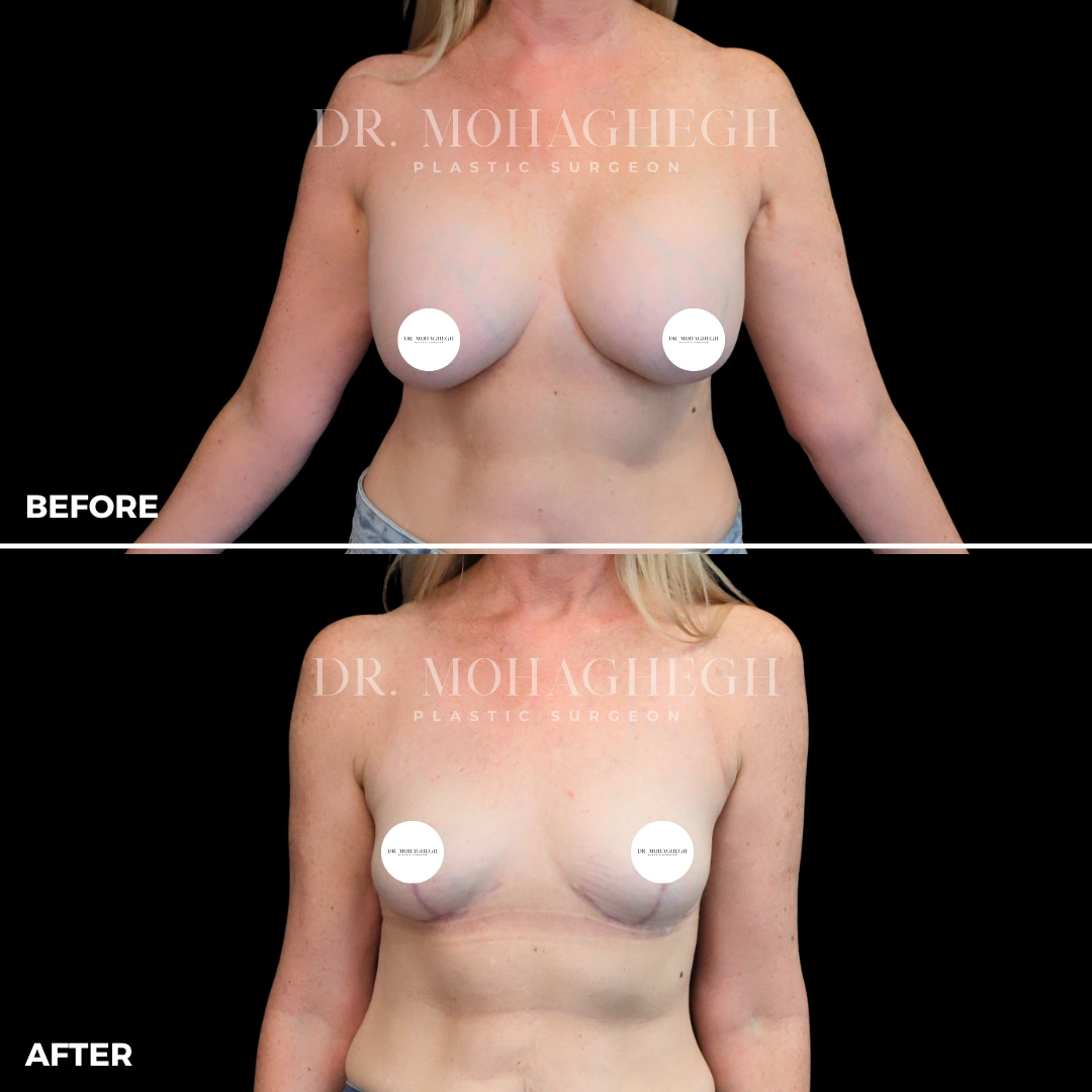 11_implant_removal_and_lift
