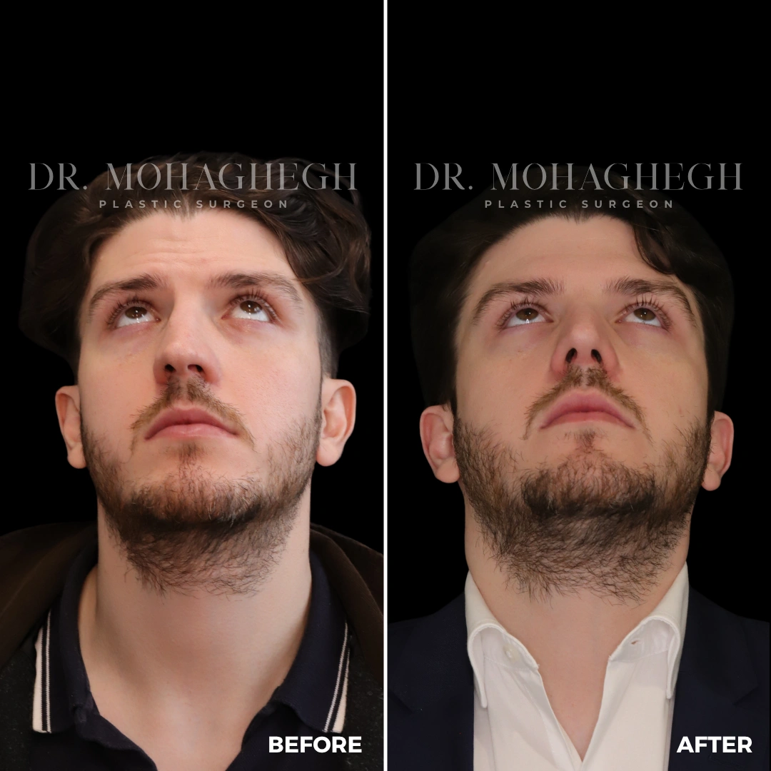 13_rhinoplasty