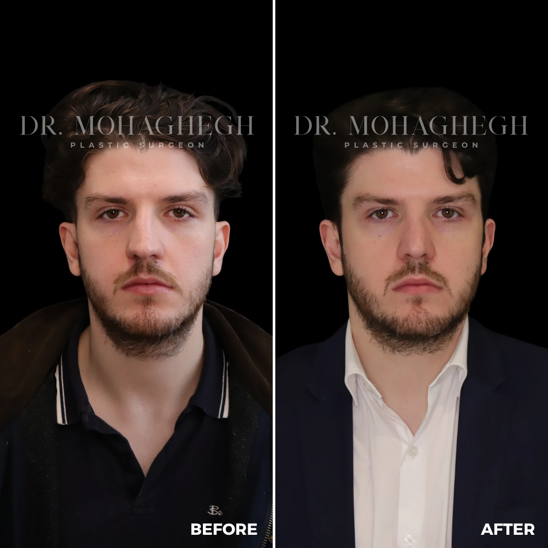 14_rhinoplasty