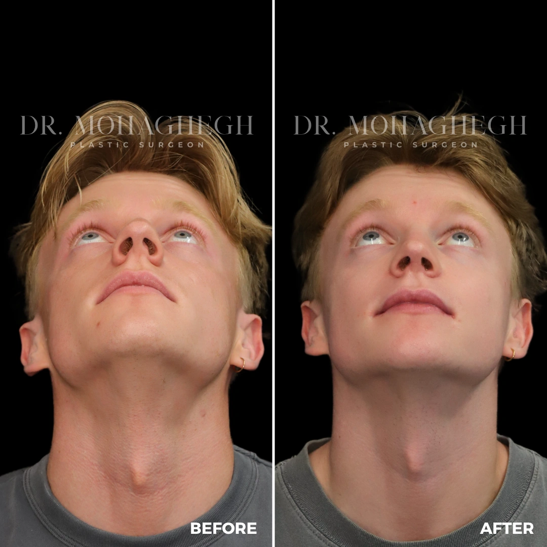 16_rhinoplasty