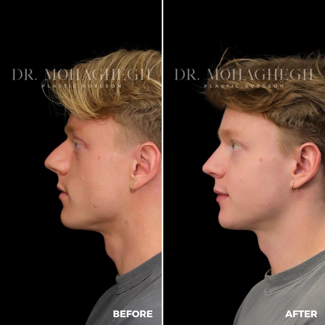 17_rhinoplasty