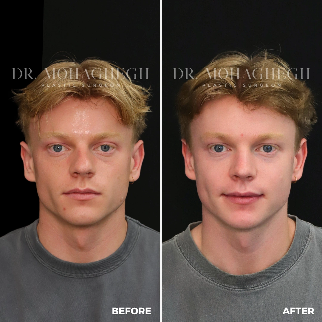 18_rhinoplasty