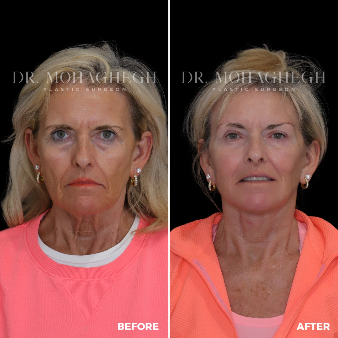 20_face_lift