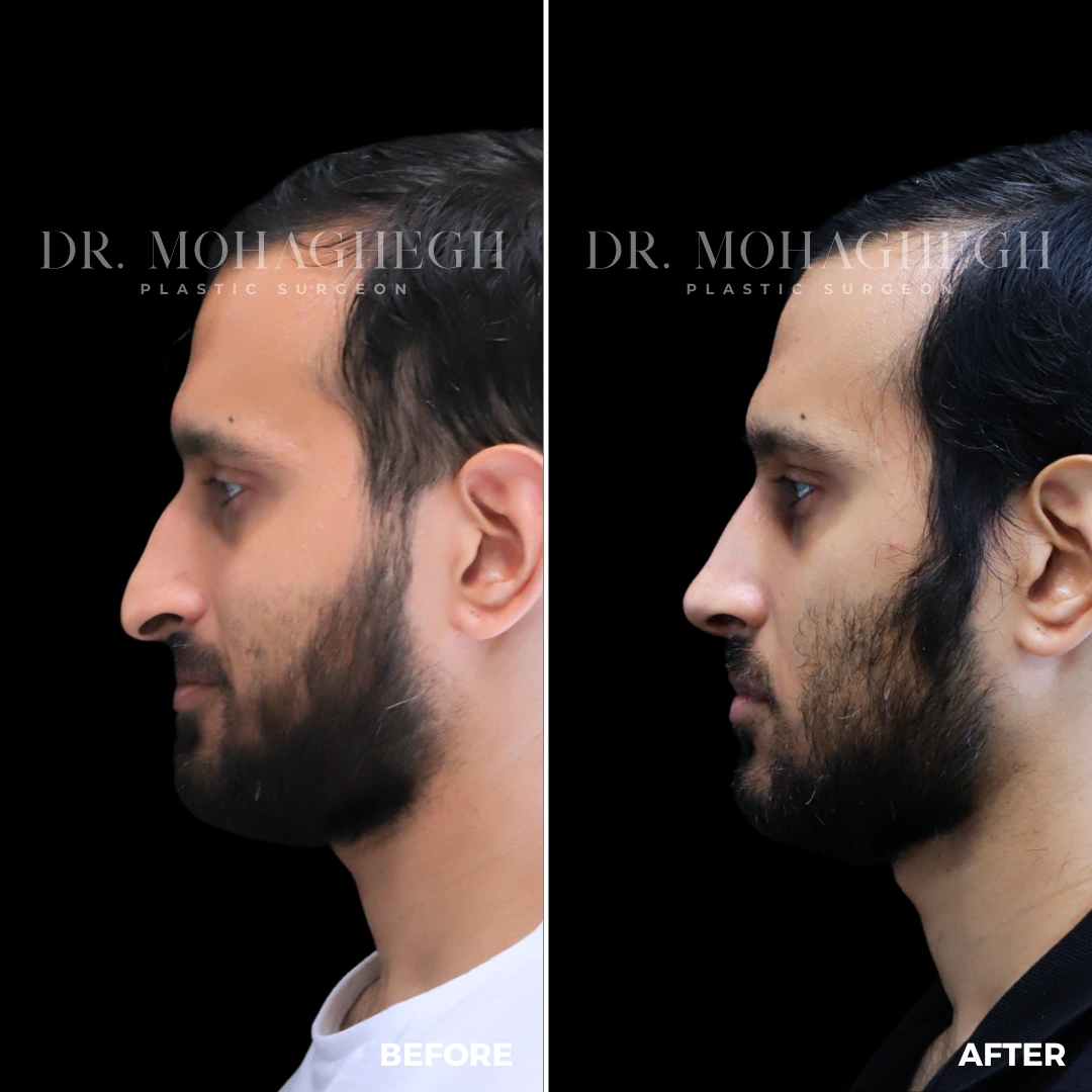 24_rhinoplasty