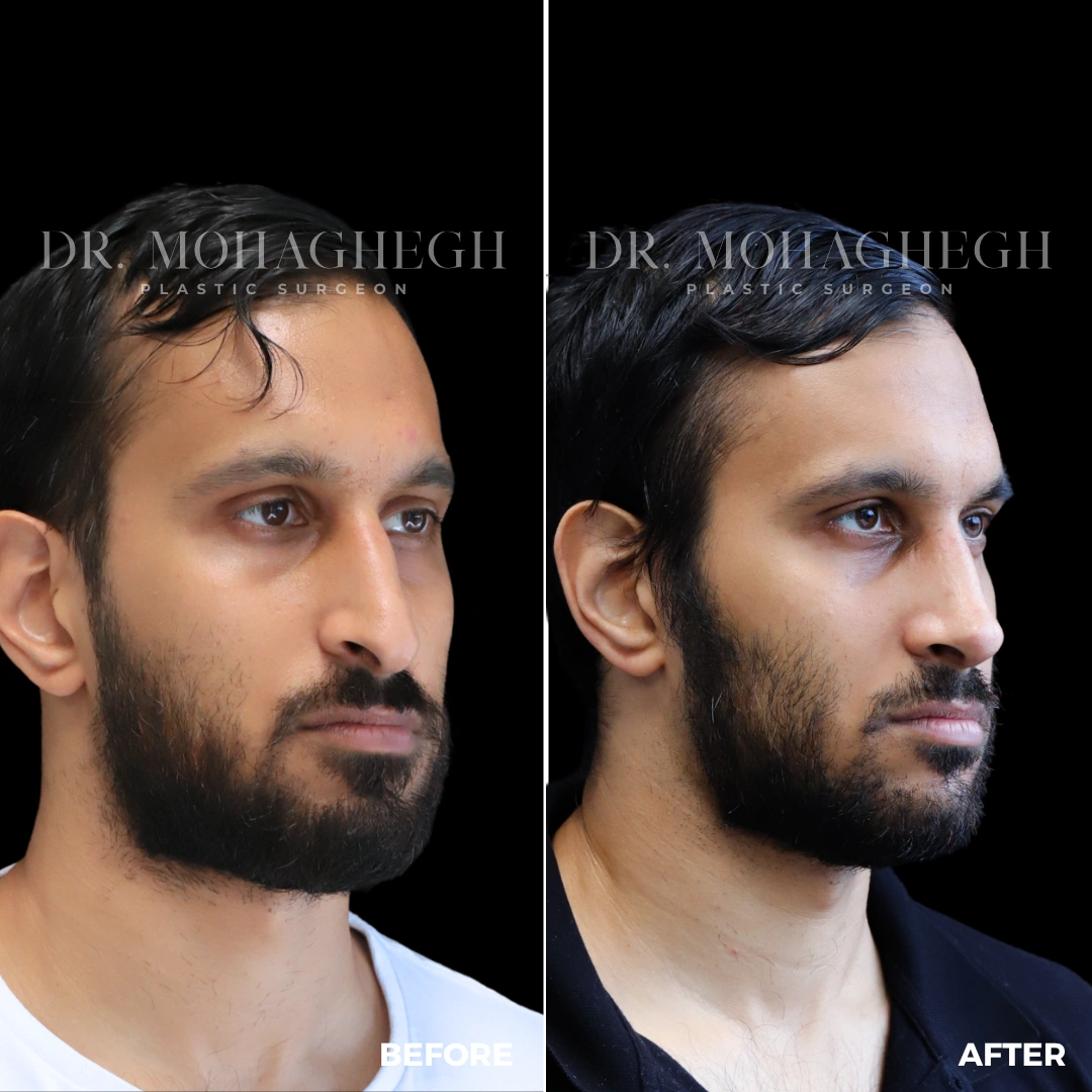 25_rhinoplasty
