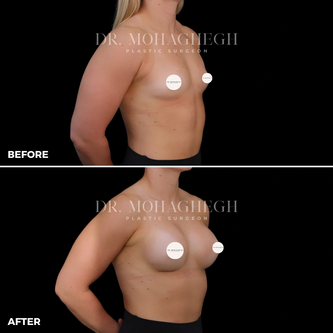 29_breast_augmentation