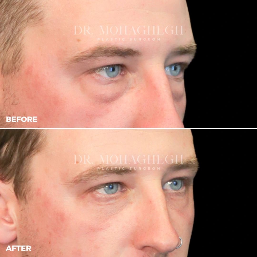 2_blepharoplasty