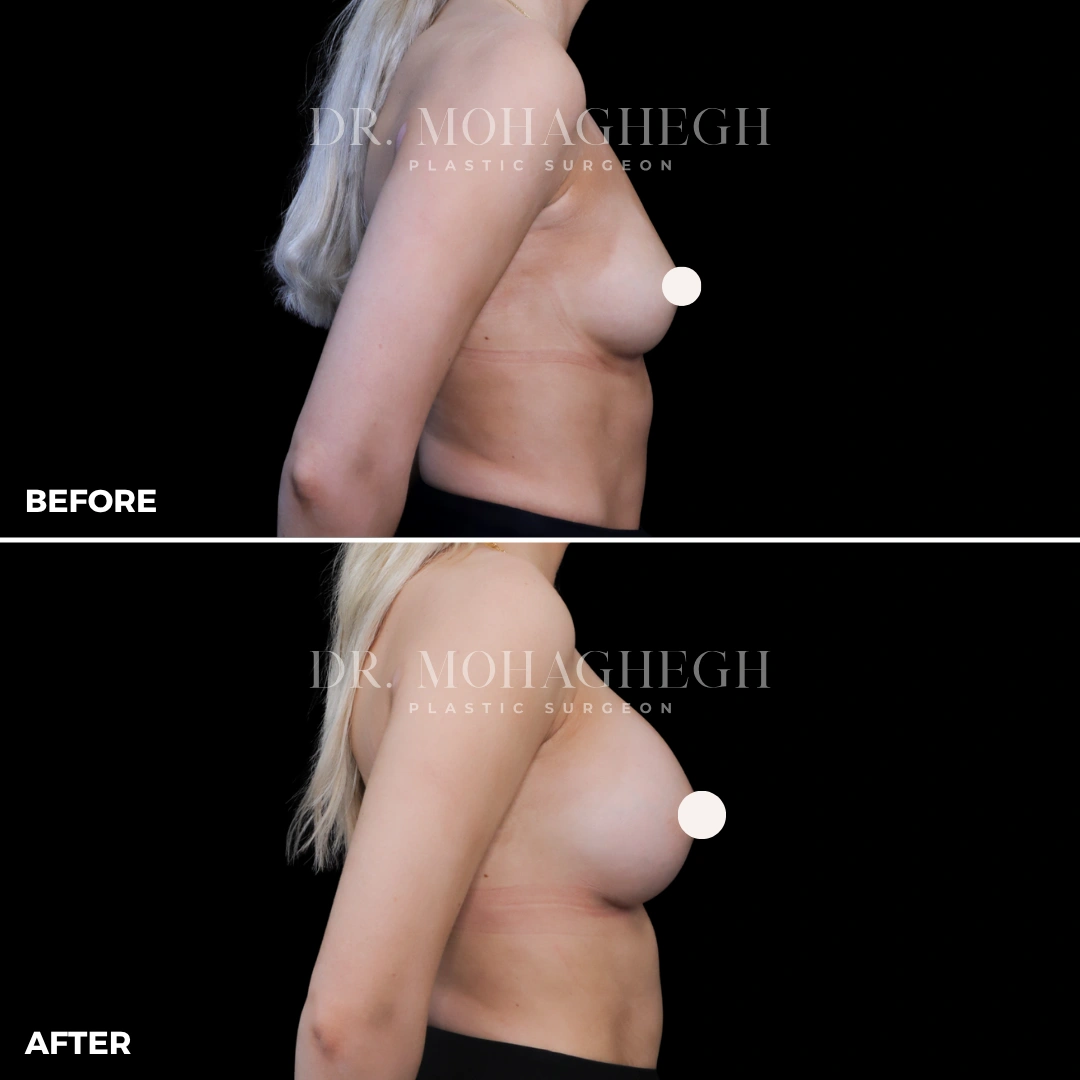 32_breast_augmentation