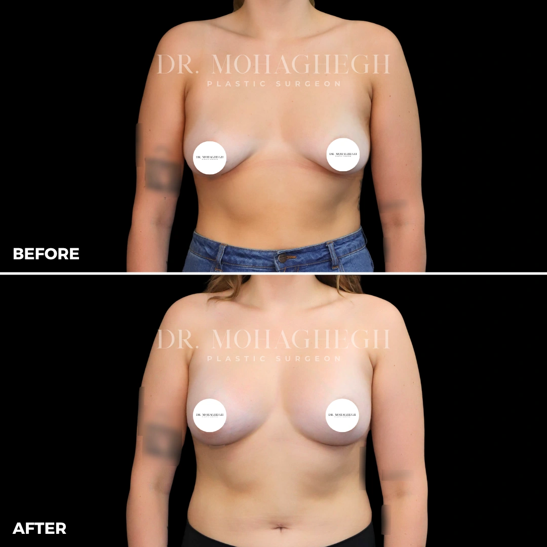 34_breast_augmentation
