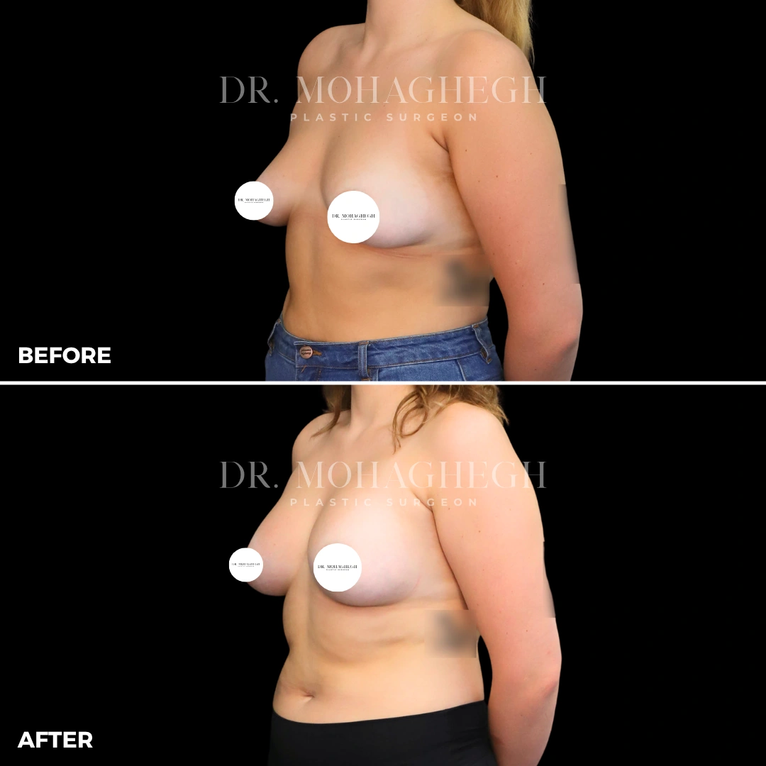 35_breast_augmentation
