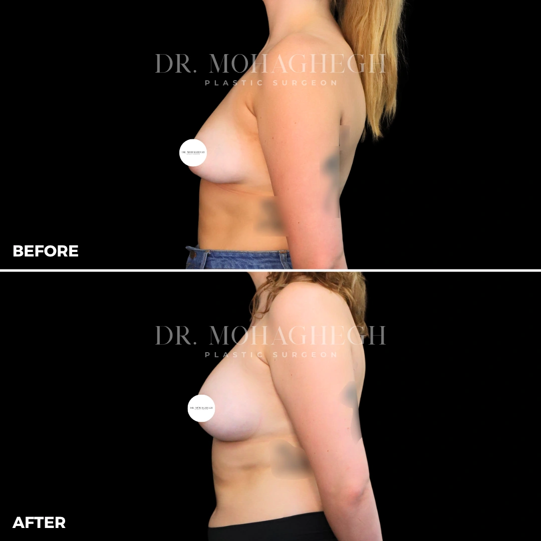 36_breast_augmentation