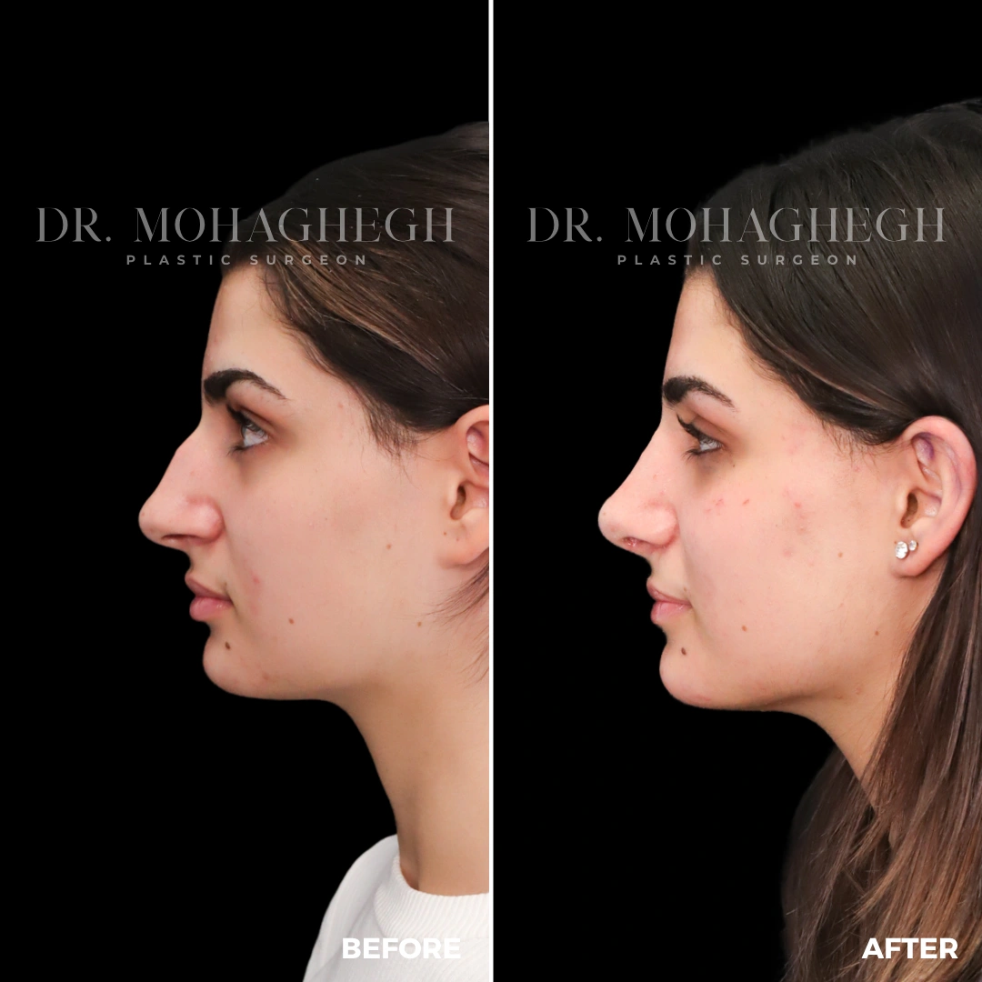 38_rhinoplasty