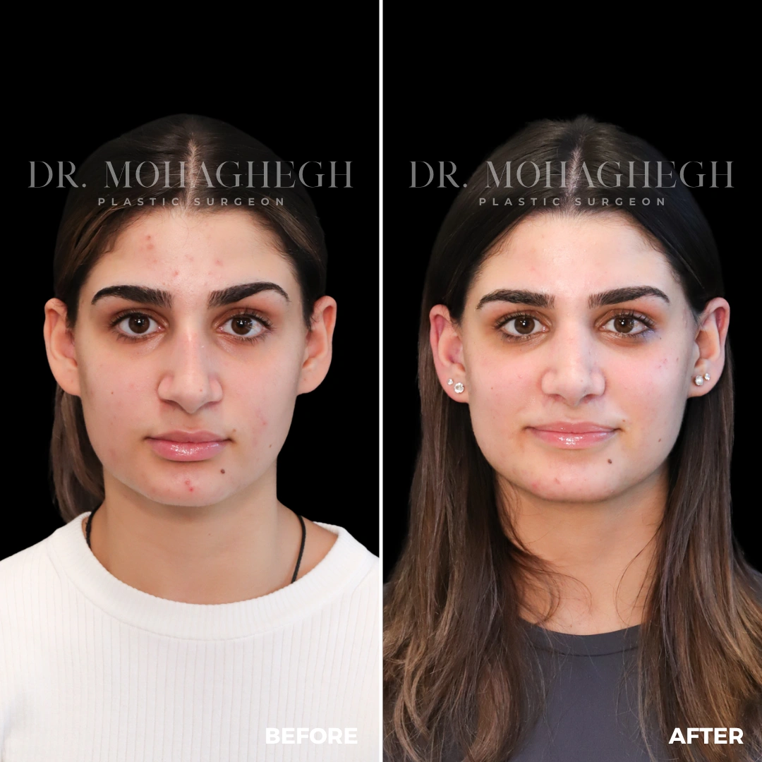 39_rhinoplasty