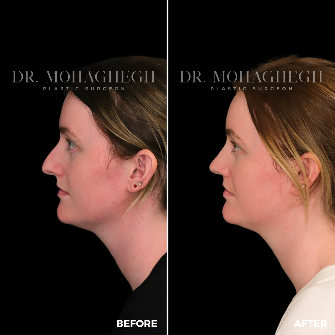 41_rhinoplasty