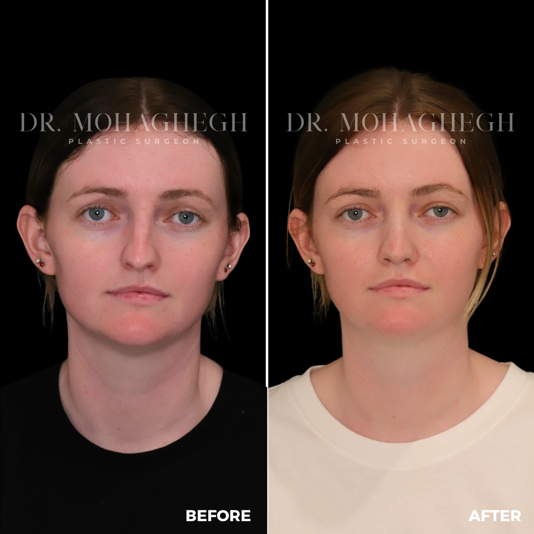 42_rhinoplasty
