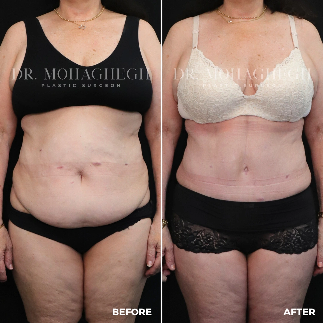 44_abdominoplasty