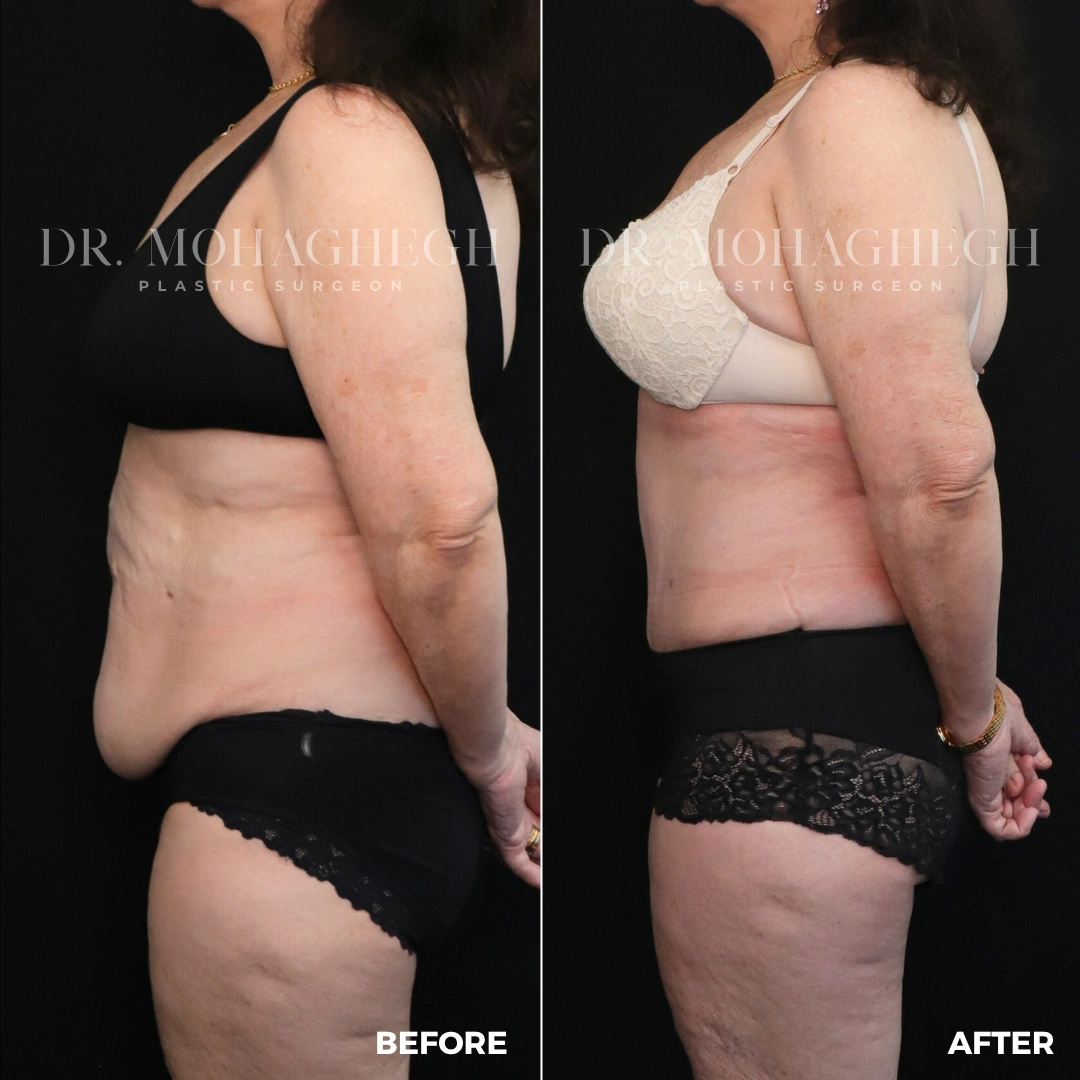 45_abdominoplasty