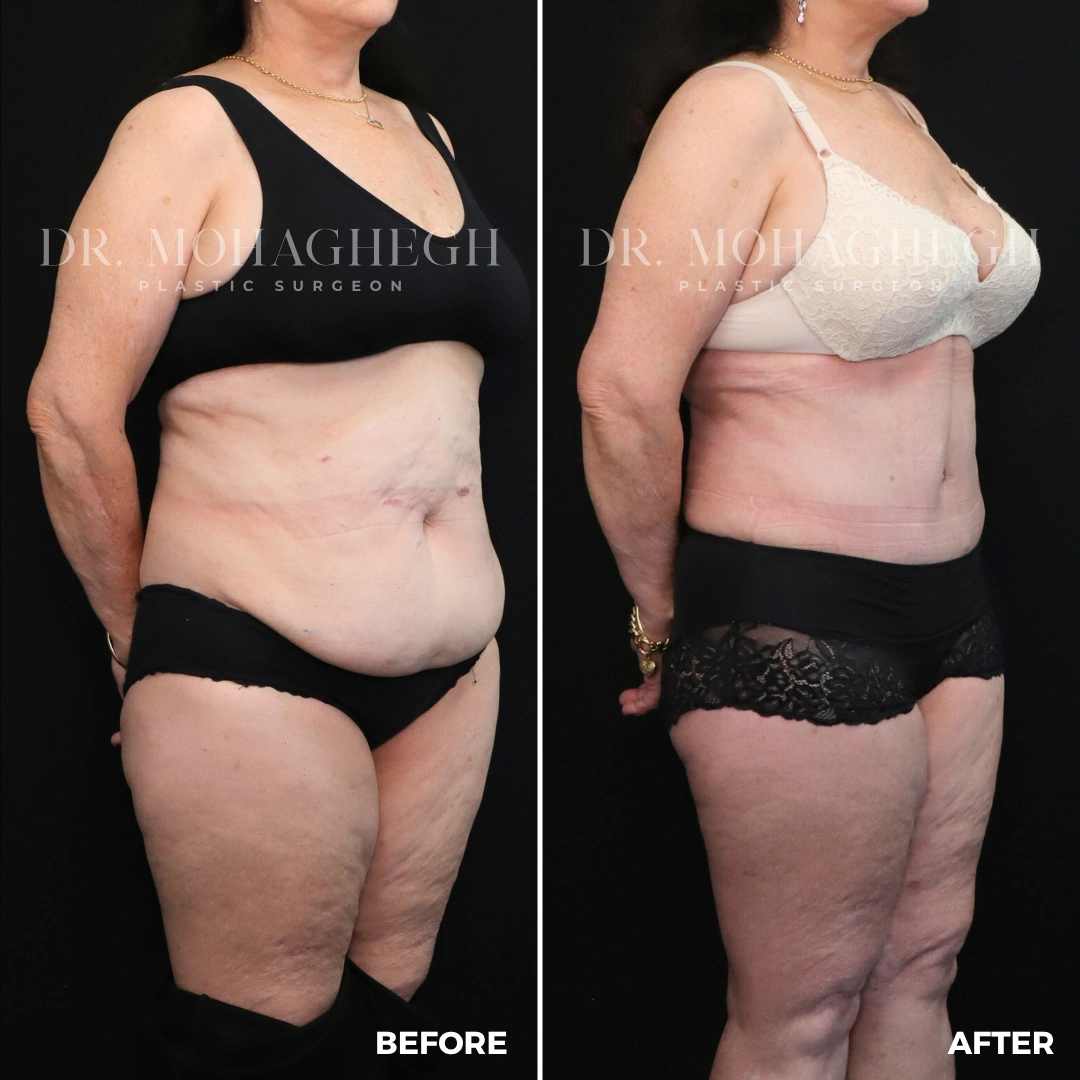 46_abdominoplasty