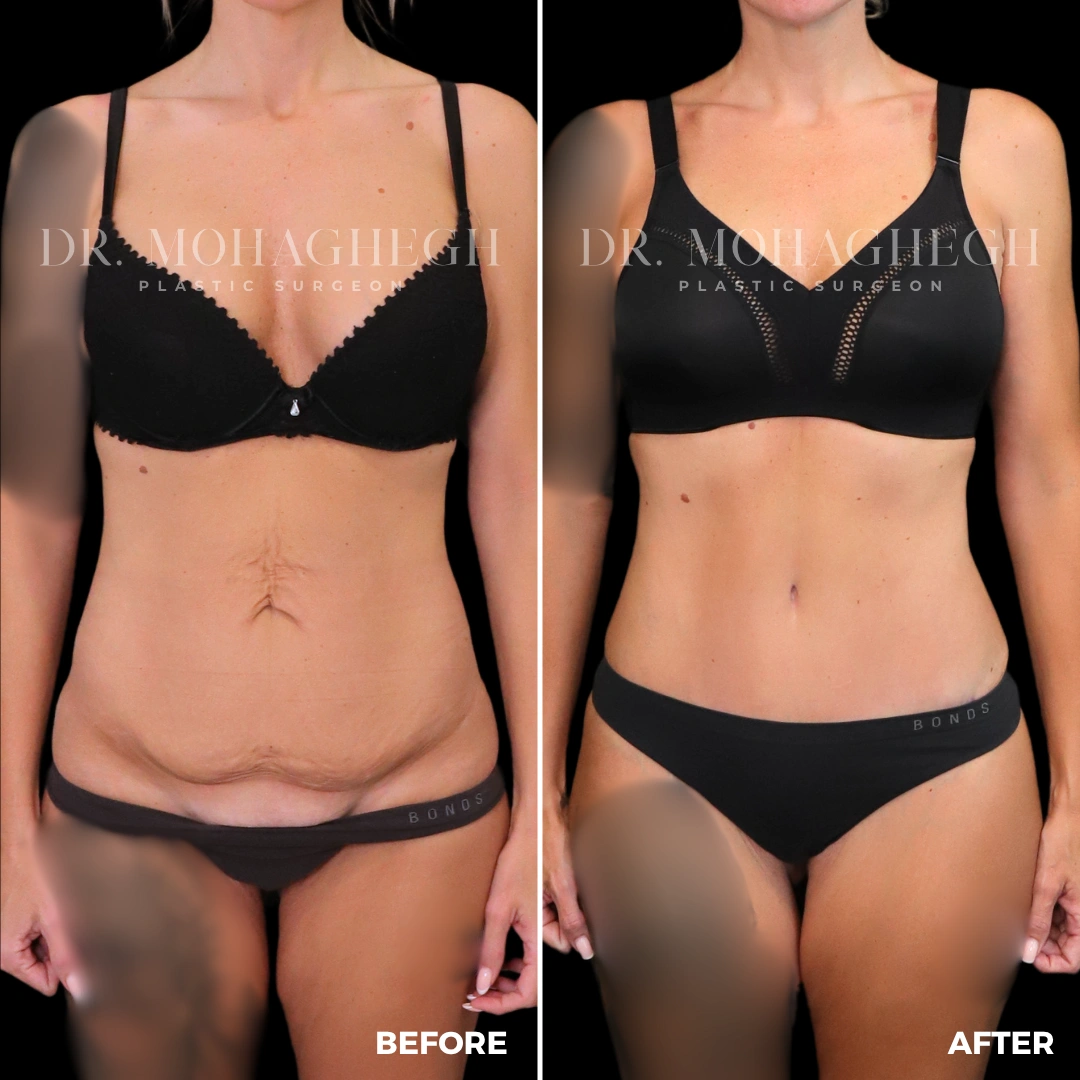48_abdominoplasty