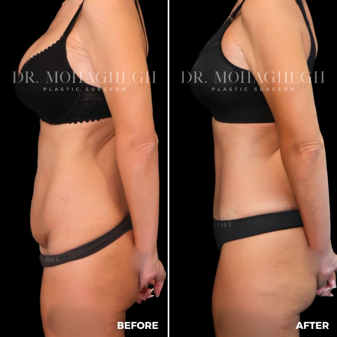 49_abdominoplasty