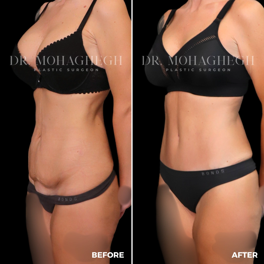 50_abdominoplasty