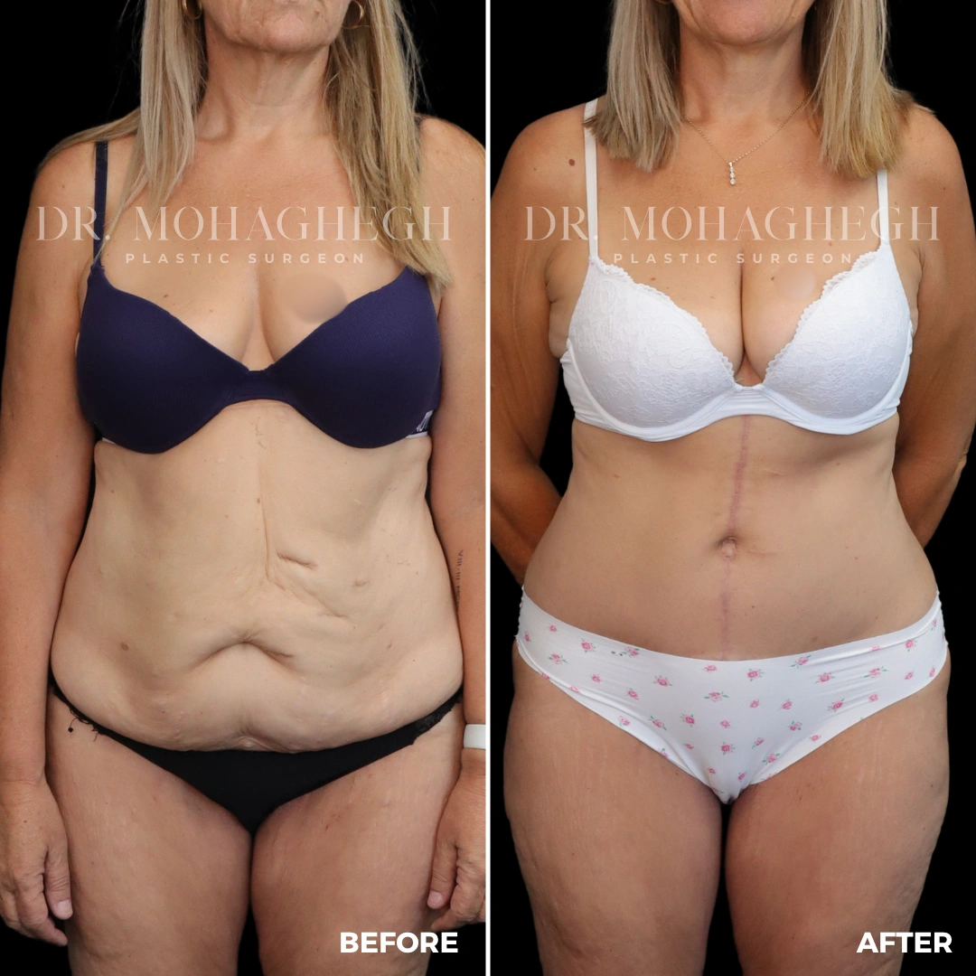 52_abdominoplasty