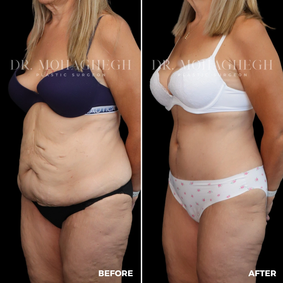 53_abdominoplasty