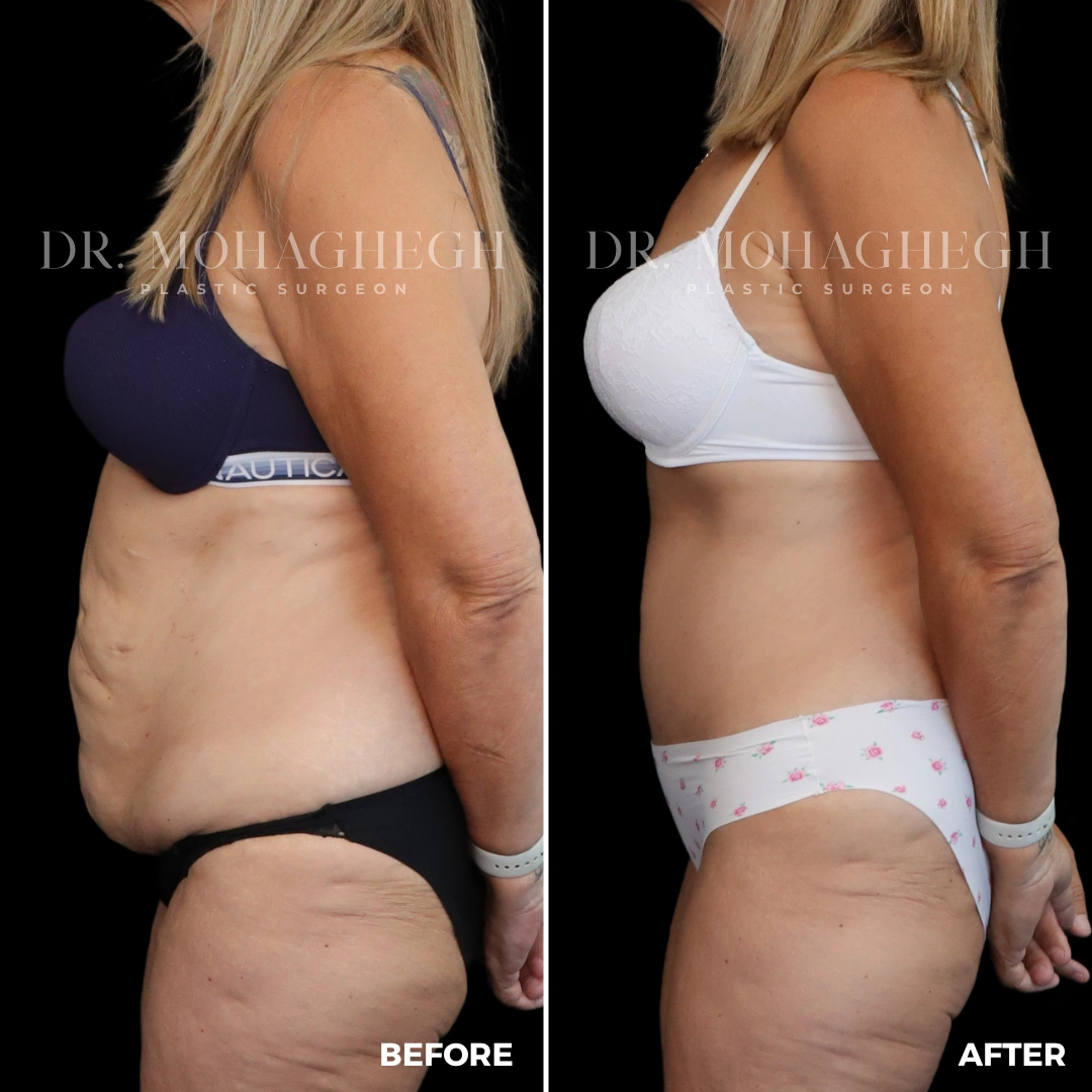 54_abdominoplasty
