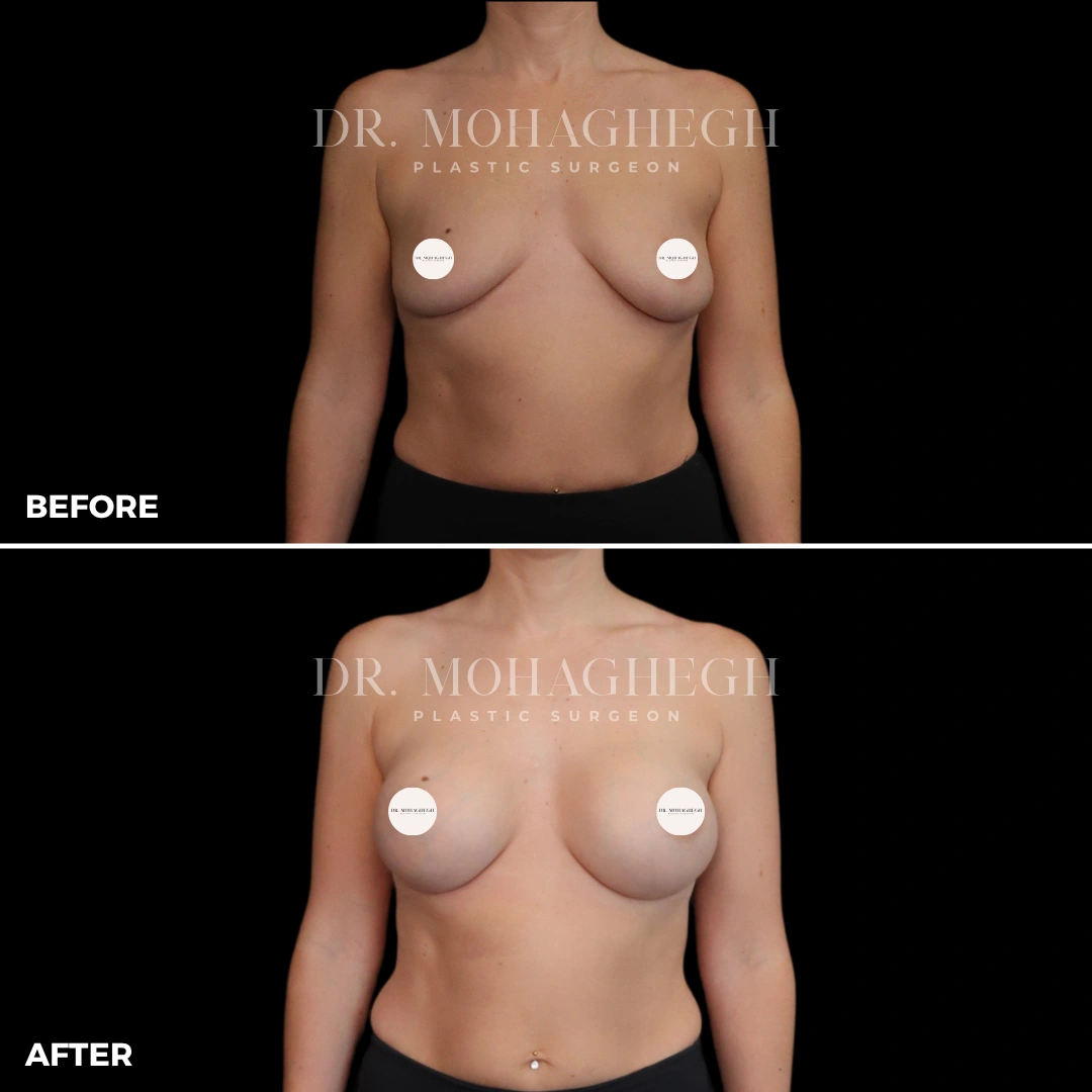 56_breast_augmentation