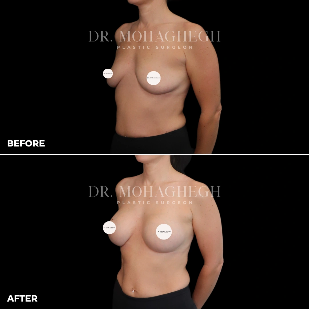 57_breast_augmentation