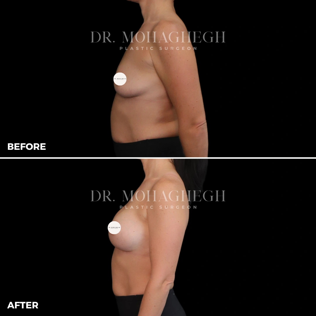 58_breast_augmentation