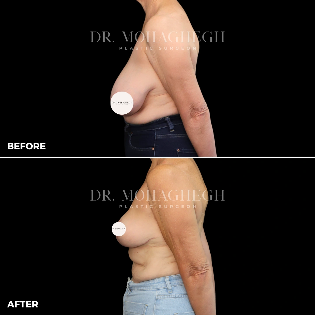 5_breast_reduction