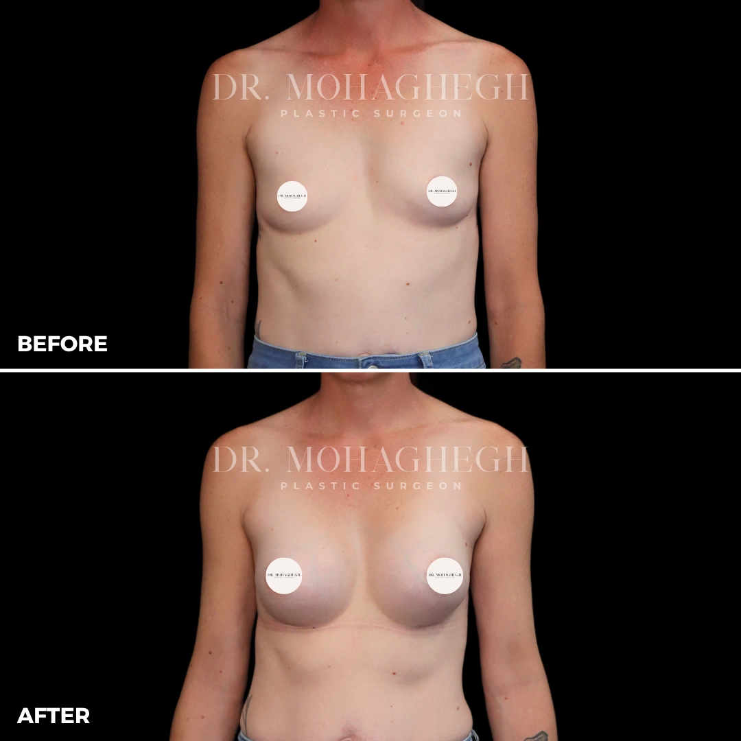 60_breast_augmentation
