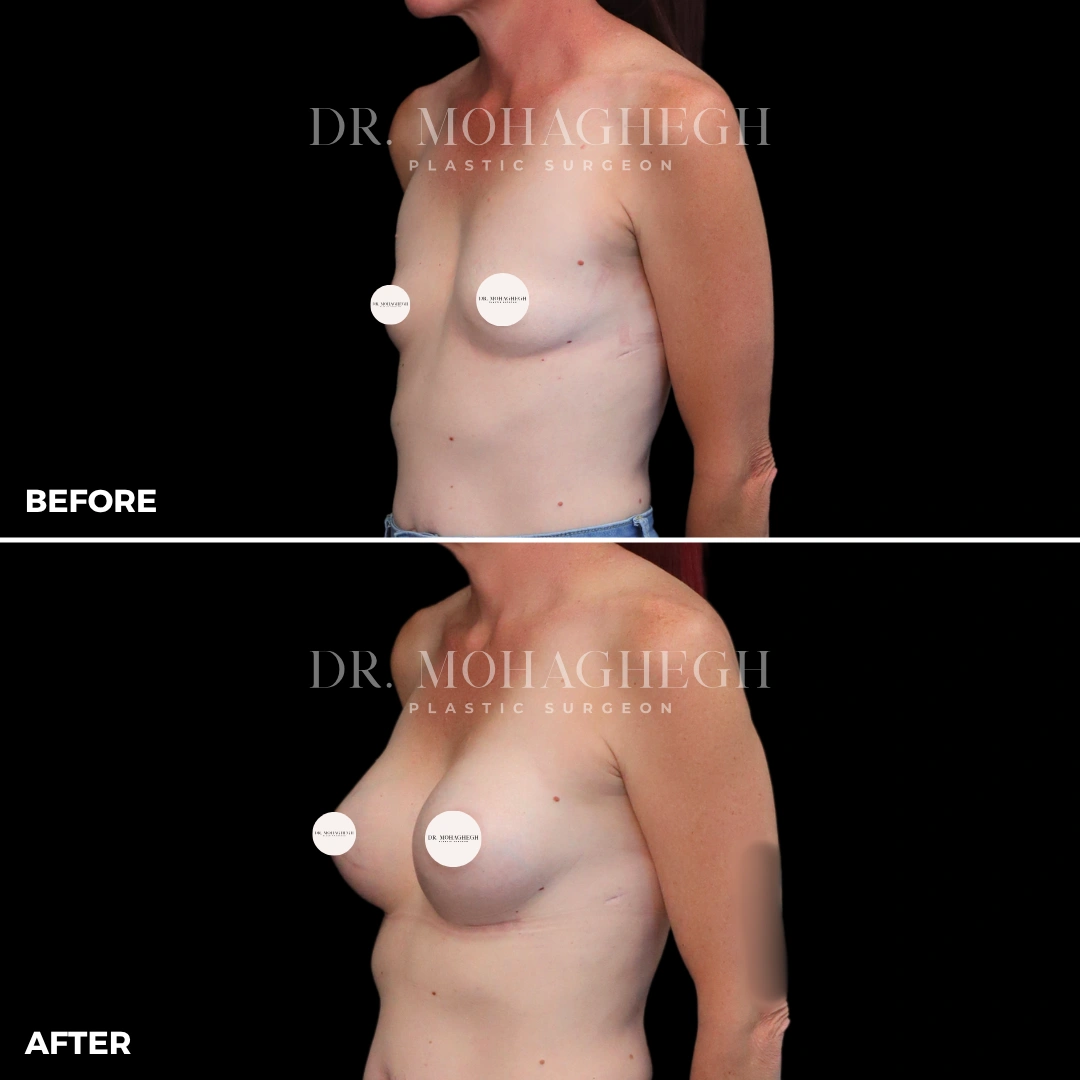 61_breast_augmentation