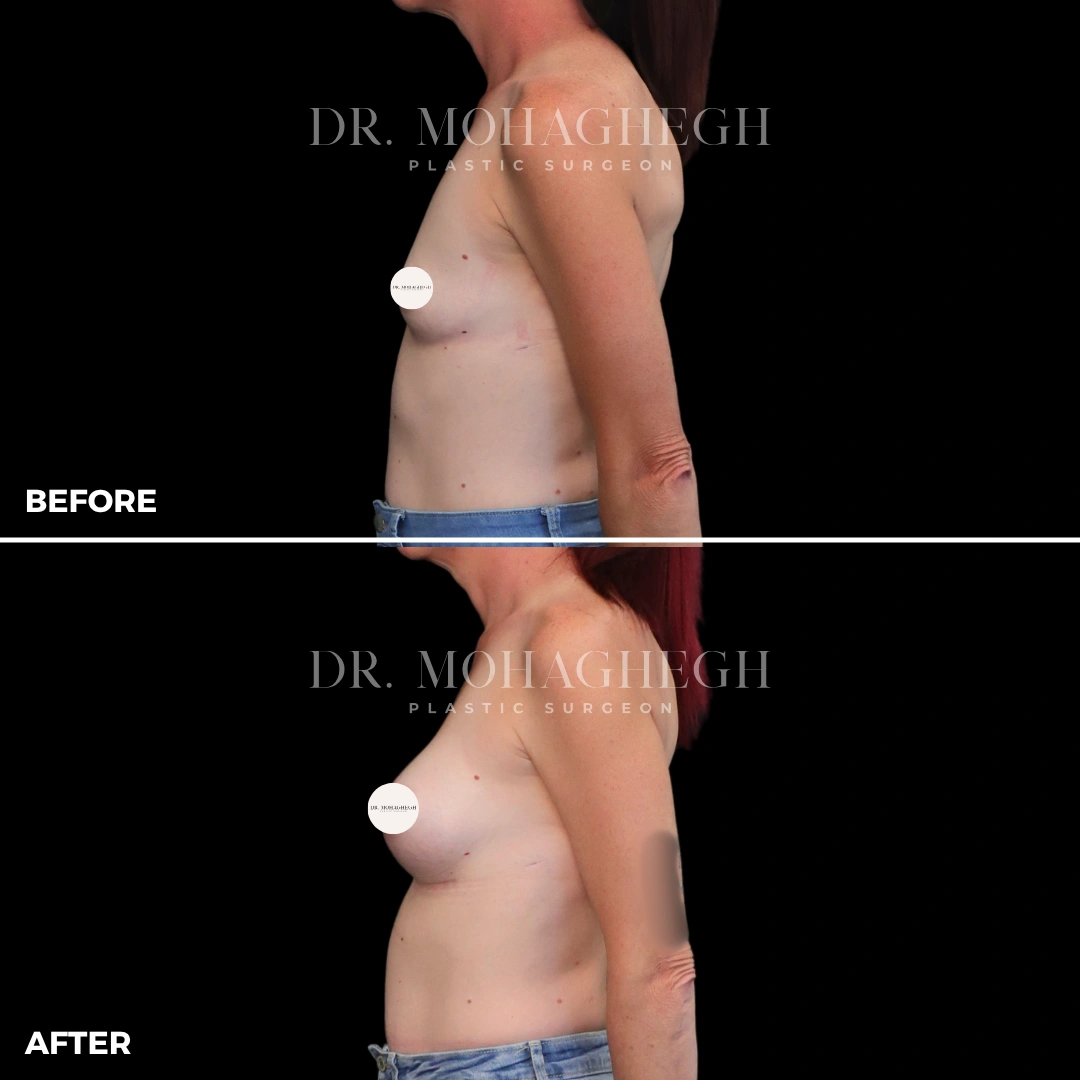 62_breast_augmentation