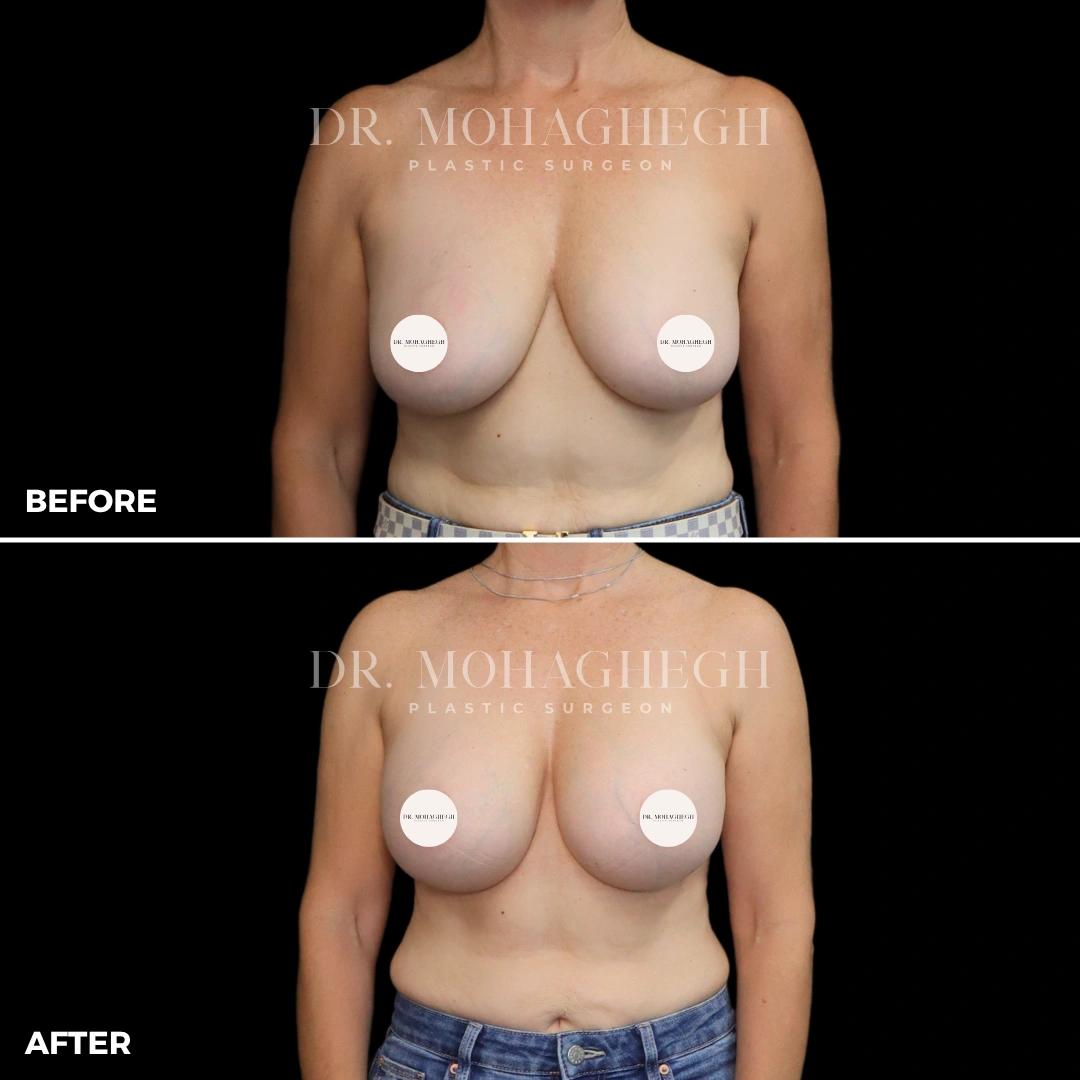 64_breast_augmentation