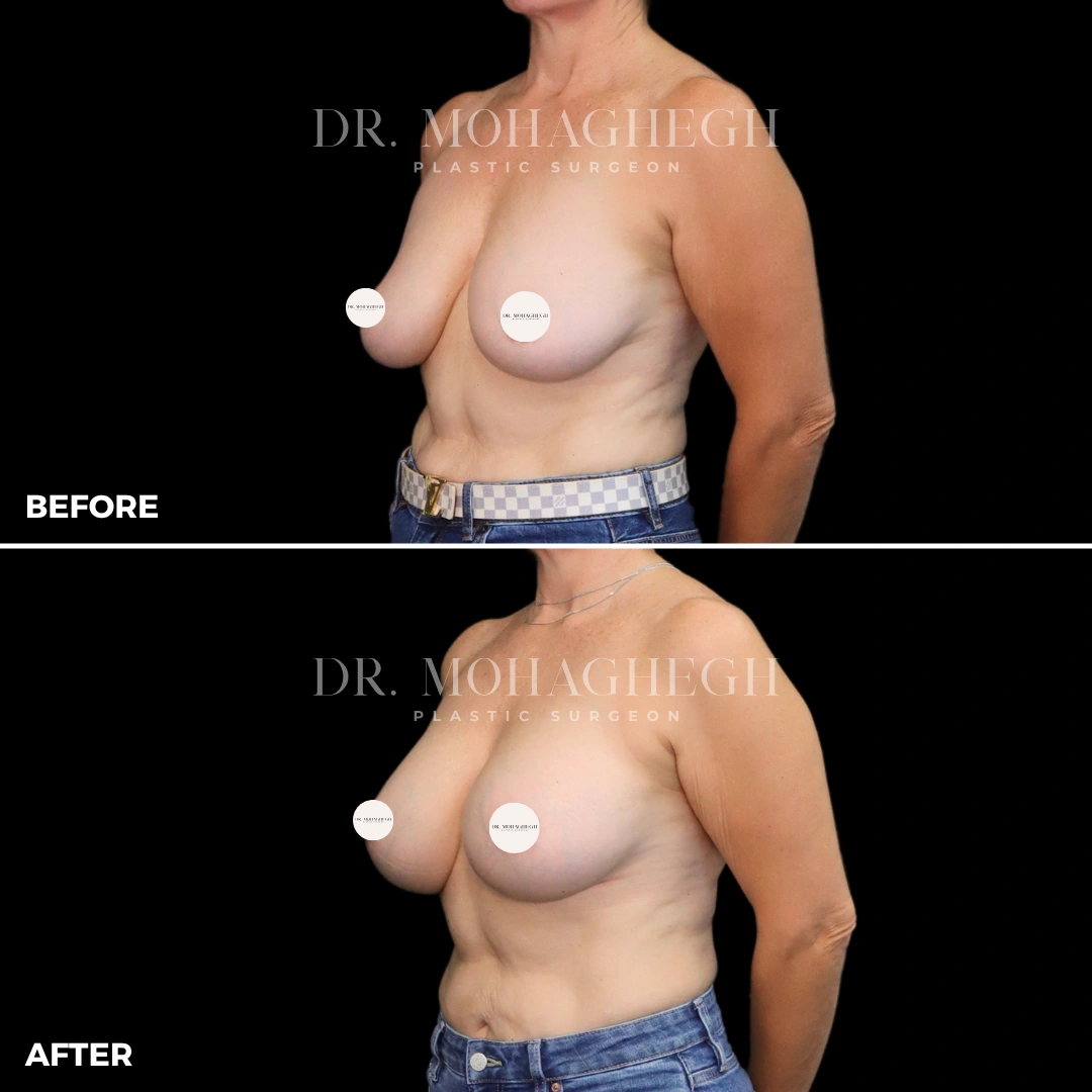 65_breast_augmentation