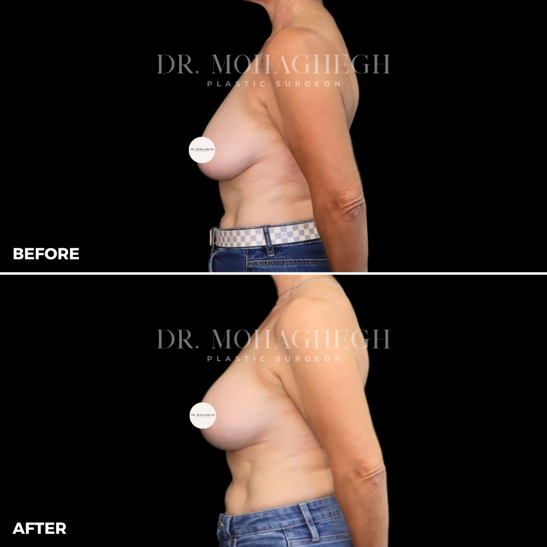 66_breast_augmentation