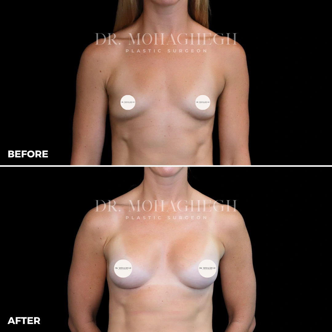 68_breast_augmentation