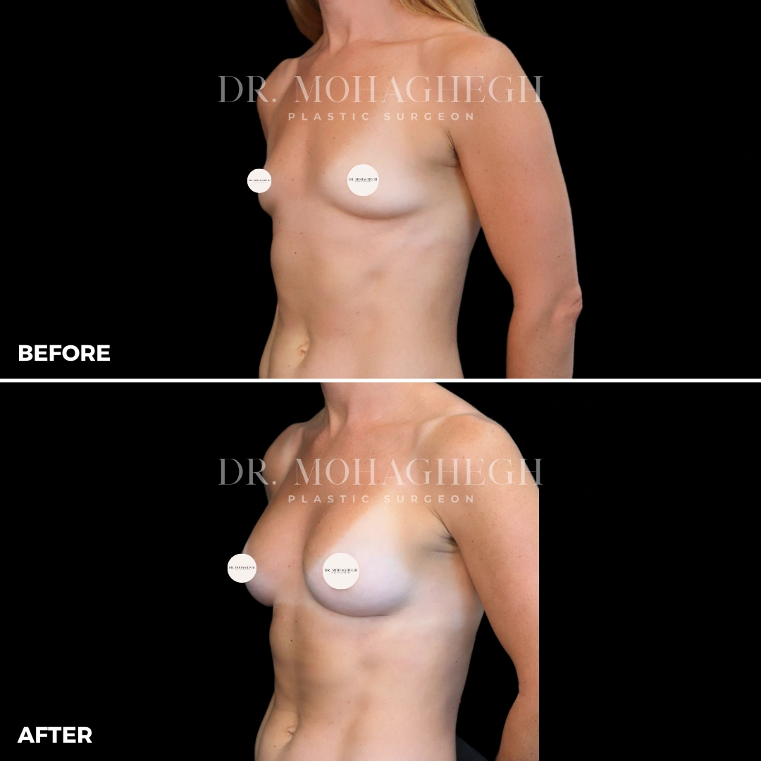 69_breast_augmentation