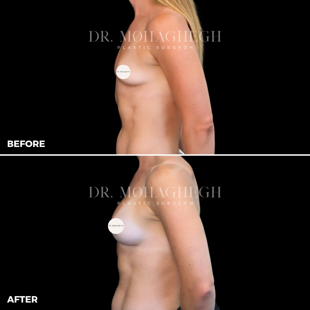 70_breast_augmentation