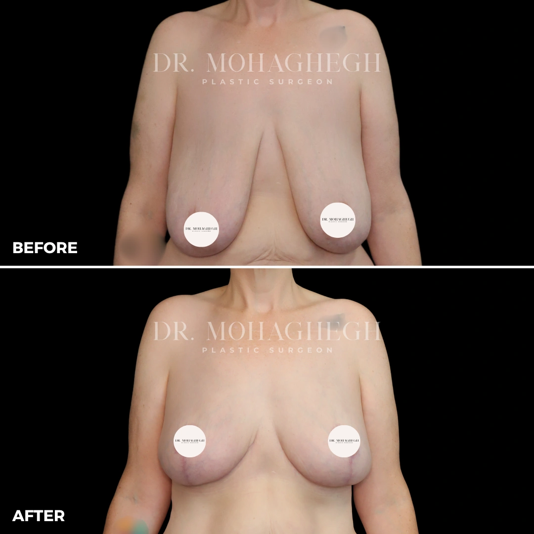72_breast_lift