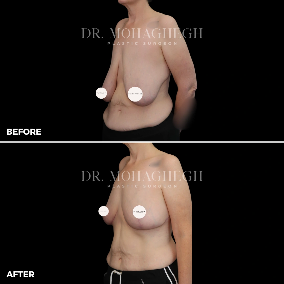 73_breast_reduction