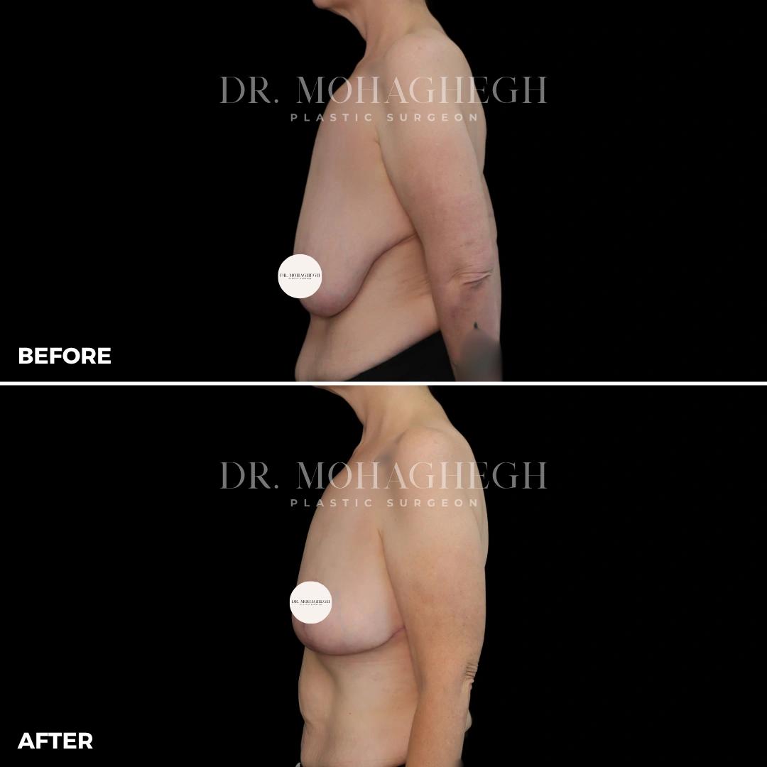 74_breast_reduction