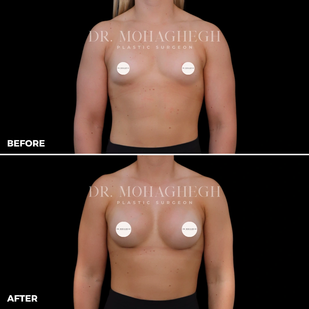 76_breast_augmentation