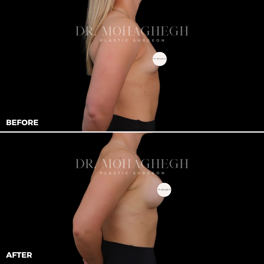 77_breast_augmentation