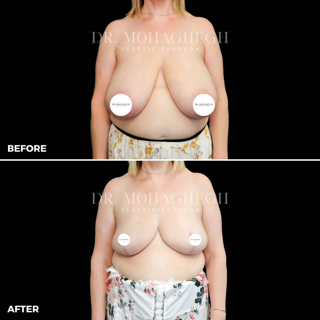 7_breast_reduction