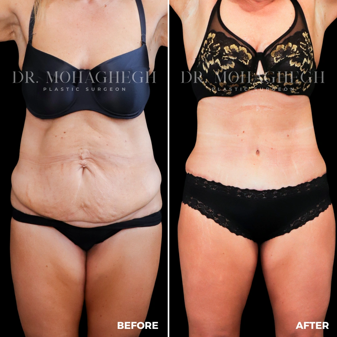 80_abdominoplasty