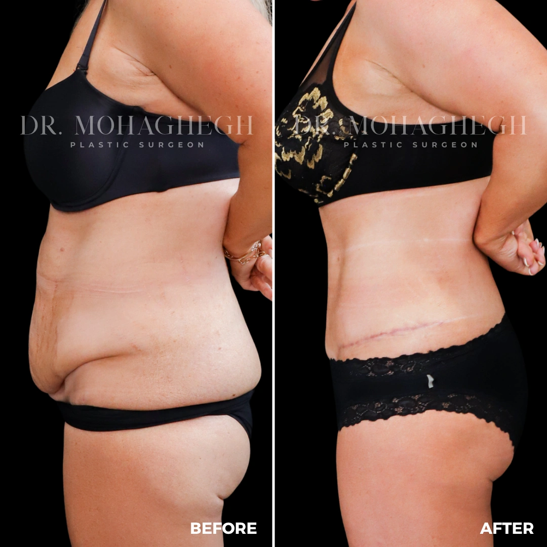 81_abdominoplasty