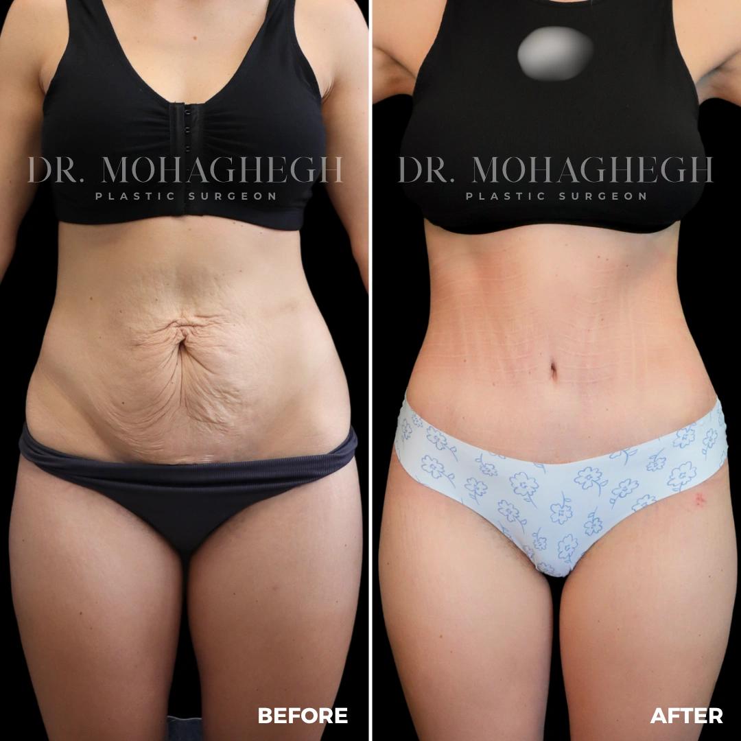 83_abdominoplasty